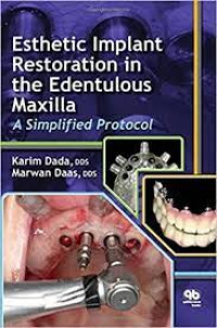 Image of Esthetic Implant Restoration in the Edentulous Maxilla