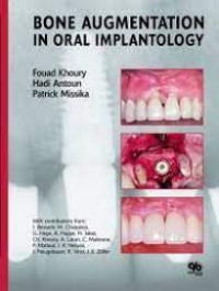 Image of Bone Augmentation in Oral Implantology